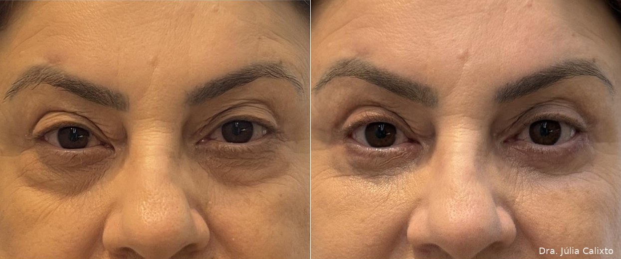 Paciente antes e após blefaroplastia superior e inferior, vista frontal