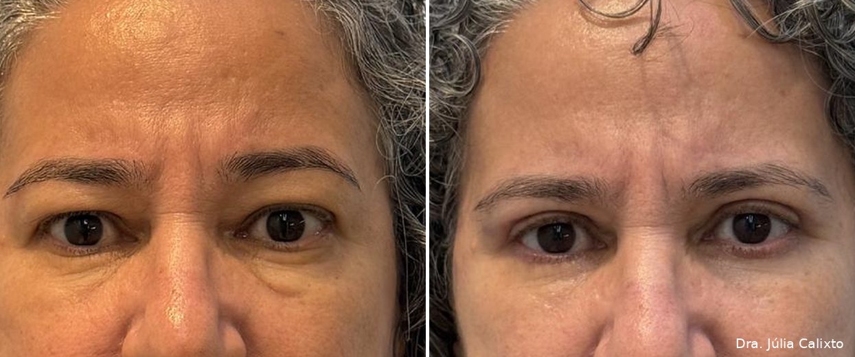 Paciente antes e após blefaroplastia superior e inferior