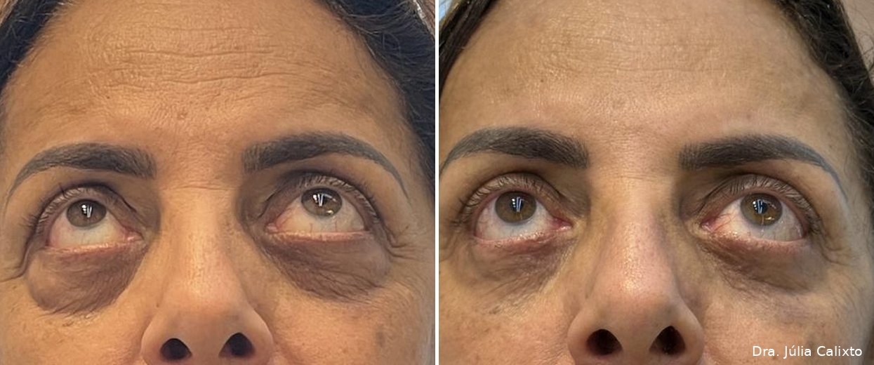 Paciente antes e após blefaroplastia inferior